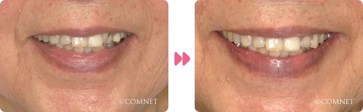 正面:奥歯の欠損術前ノンクラスプデンチャー