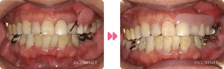 口腔内:奥歯の欠損術前ノンクラスプデンチャー