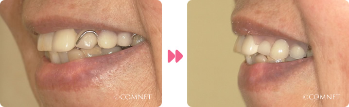 左側:奥歯の欠損術前ノンクラスプデンチャー