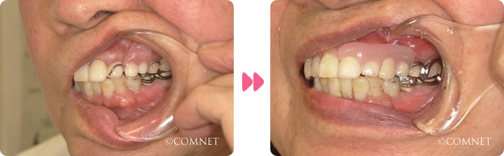 バネ:奥歯の欠損術前ノンクラスプデンチャー